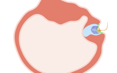 Light Cupula – What Is It and What Should I Do About It?